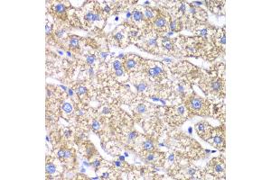 Immunohistochemistry of paraffin-embedded human liver injury using DLST antibody (ABIN6292010) at dilution of 1:100 (40x lens). (DLST Antikörper)
