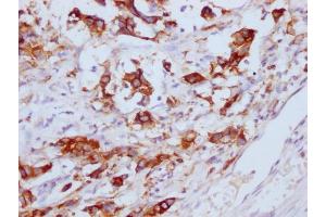 IHC image of ABIN7180656 diluted at 1:100 and staining in paraffin-embedded human gastric cancer performed on a Leica BondTM system. (CEACAM5 Antikörper)