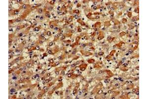 Immunohistochemistry of paraffin-embedded human liver cancer using ABIN7173471 at dilution of 1:100 (TRIM59 Antikörper  (AA 126-181))