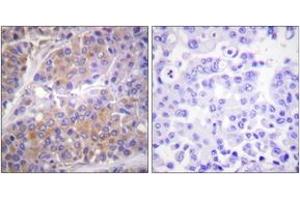 Immunohistochemistry analysis of paraffin-embedded human breast carcinoma, using p70 S6 Kinase (Phospho-Ser371) Antibody. (RPS6KB1 Antikörper  (pSer371))