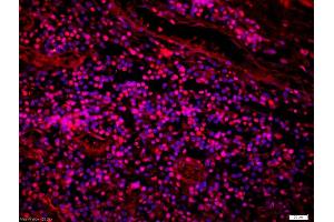 Formalin-fixed and paraffin-embedded human lung carcinoma labeled with Anti-FOXN1 Polyclonal Antibody, Unconjugated (ABIN1387592) 1:200, overnight at 4°C, The secondary antibody was Goat Anti-Rabbit IgG, Cy3 conjugated used at 1:200 dilution for 40 minutes at 37°C. (FOXN1 Antikörper  (AA 321-420))