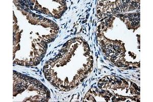 Immunohistochemical staining of paraffin-embedded Adenocarcinoma of breast tissue using anti-DCXR mouse monoclonal antibody. (DCXR Antikörper)