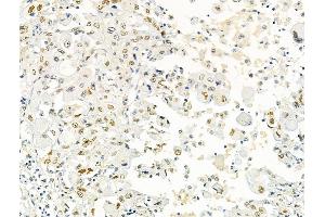ABIN6266359 and ABIN6276704 at 1/100 staining Human lung cancer by IHC-P. (PRMT5 Antikörper  (Internal Region))