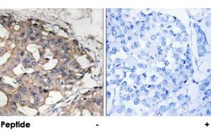 Immunohistochemical analysis of paraffin-embedded human breast carcinoma tissue using BRAF polyclonal antibody . (BRAF Antikörper)