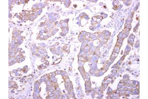 IHC-P Image Bif-1 antibody detects Bif-1 protein at cytosol on human ovarian carcinoma by immunohistochemical analysis. (ZBTB24 Antikörper  (C-Term))