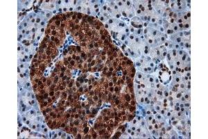 Immunohistochemical staining of paraffin-embedded Adenocarcinoma of colon tissue using anti-SIL1 mouse monoclonal antibody. (SIL1 Antikörper)