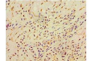 Immunohistochemistry of paraffin-embedded human breast cancer using ABIN7168521 at dilution of 1:100 (AHCYL1 Antikörper  (AA 31-260))