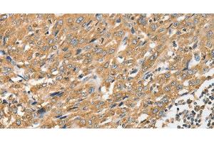 Immunohistochemistry of paraffin-embedded Human esophagus cancer tissue using ANGPTL7 Polyclonal Antibody at dilution 1:40 (ANGPTL7 Antikörper)