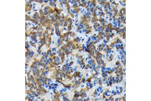 Immunohistochemistry of paraffin-embedded human thyroid cancer using Thyroid Peroxidase Rabbit mAb (ABIN7270865) at dilution of 1:100 (40x lens). (TPO Antikörper)