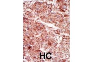 Formalin-fixed and paraffin-embedded human cancer tissue reacted with the primary antibody, which was peroxidase-conjugated to the secondary antibody, followed by AEC staining. (HK3 Antikörper  (C-Term))