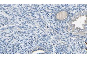 ABIN6272591 at 1/100 staining Human cervical cancer tissue by IHC-P. (IFI6 Antikörper)