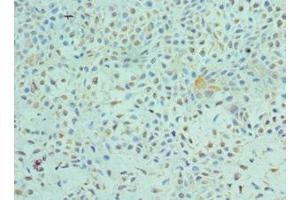 Immunohistochemistry of paraffin-embedded human breast cancer using ABIN7172544 at dilution of 1:100 (ETV6 Antikörper  (AA 1-300))