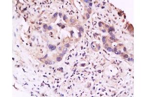 Formalin-fixed and paraffin embedded human gastric carcinoma labeled with Anti-IL-23R Polyclonal Antibody, Unconjugated  at 1:200 followed by conjugation to the secondary antibody and DAB staining (IL23R Antikörper  (AA 401-550))