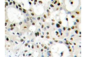 Immunohistochemistry analyzes of hnRNP A1 antibody in paraffin-embedded human liver carcinoma tissue. (HNRNPA1 Antikörper)