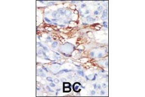 Formalin-fixed and paraffin-embedded human cancer tissue reacted with the primary antibody, which was peroxidase-conjugated to the secondary antibody, followed by DAB staining. (PDGFRL Antikörper  (C-Term))