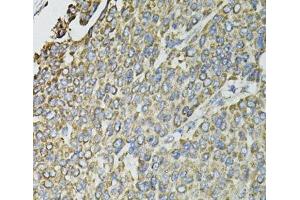 Immunohistochemistry of paraffin-embedded Human liver cancer using RASSF1 Polyclonal Antibody at dilution of 1:100 (40x lens). (RASSF1 Antikörper)