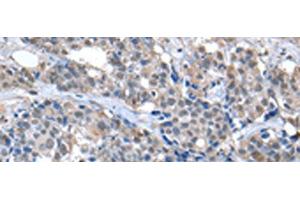 Immunohistochemistry of paraffin-embedded Human breast cancer tissue using ZFP2 Polyclonal Antibody at dilution of 1:40(x200) (ZFP2 Antikörper)