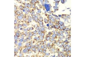 Immunohistochemistry of paraffin-embedded human esophageal cancer using GLUD2 antibody at dilution of 1:100 (x40 lens). (GLUD2 Antikörper)