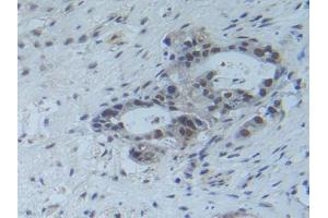IHC-P analysis of Human Pancreas Cancer Tissue, with DAB staining. (RFTN1 Antikörper  (AA 288-520))