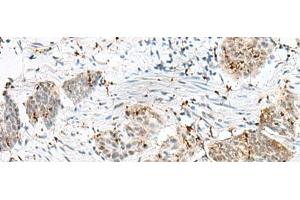 Immunohistochemistry of paraffin-embedded Human esophagus cancer tissue using PLCL2 Polyclonal Antibody at dilution of 1:50(x200) (PLCL2 Antikörper)