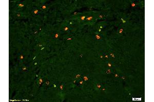 Formalin-fixed and paraffin embedded human glioma tissue labeled with Anti Lyn Polyclonal Antibody, PE conjugated (ABIN681493) at 1:200 dilution for 60 minutes at 37°C. (LYN Antikörper  (AA 201-300))