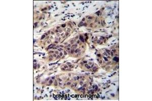 WDR42C Antibody (N-term) (ABIN655843 and ABIN2845256) immunohistochemistry analysis in formalin fixed and paraffin embedded human breast carcinoma followed by peroxidase conjugation of the secondary antibody and DAB staining. (DCAF8L2 Antikörper  (N-Term))