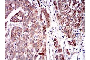 Immunohistochemical analysis of paraffin-embedded liver cancer tissues using SERPINA7 mouse mAb with DAB staining. (SERPINA7 Antikörper  (AA 168-302))