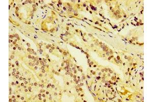 IHC image of ABIN7149752 diluted at 1:400 and staining in paraffin-embedded human prostate cancer performed on a Leica BondTM system. (Dermcidin Antikörper  (AA 20-110))