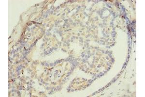 Immunohistochemistry of paraffin-embedded human breast cancer using ABIN7176453 at dilution of 1:100 (ZNF626 Antikörper  (AA 1-92))