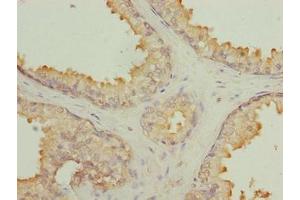 Immunohistochemistry of paraffin-embedded human prostate cancer using ABIN7145497 at dilution of 1:100 (GLB1L2 Antikörper  (AA 401-636))