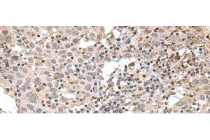 Immunohistochemistry of paraffin-embedded Human cervical cancer tissue using TDP2 Polyclonal Antibody at dilution of 1:75(x200) (TDP2 Antikörper)