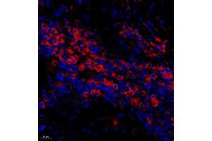 Immunofluorescence of paraffin embedded human cervical cancer using BTBD6 (ABIN7073235) at dilution of 1:50 (400x lens) (BTBD6 Antikörper)