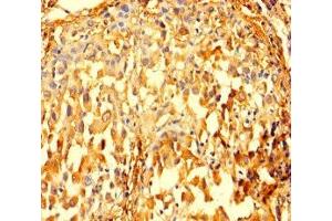 Immunohistochemistry of paraffin-embedded human lung cancer using ABIN7156292 at dilution of 1:100 (IMPDH2 Antikörper  (AA 5-514))