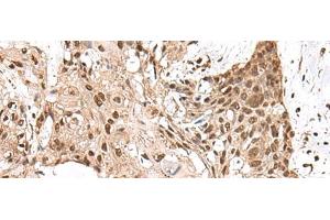 Immunohistochemistry of paraffin-embedded Human esophagus cancer tissue using MAGOHB Polyclonal Antibody at dilution of 1:70(x200) (Mago Nashi Homolog 2 Antikörper)