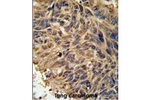 FBXL2 Antibody (C-term) (ABIN651220 and ABIN2840138) IHC analysis in formalin fixed and paraffin embedded human lung carcinoma followed by peroxidase conjugation of the secondary antibody and DAB staining.
