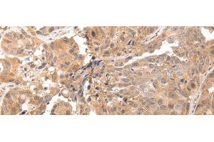 Immunohistochemistry of paraffin-embedded Human breast cancer tissue using CLDND2 Polyclonal Antibody at dilution 1:45 (CLDND2 Antikörper)