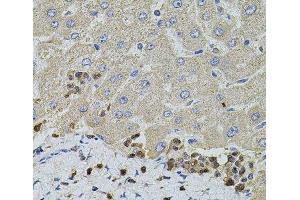 Immunohistochemistry of paraffin-embedded Human liver damage using S100A12 Polyclonal Antibody at dilution of 1:100 (40x lens). (S100A12 Antikörper)
