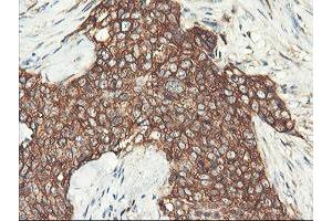 Immunohistochemical staining of paraffin-embedded Adenocarcinoma of Human breast tissue using anti-PFKP mouse monoclonal antibody.