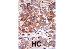 Formalin-fixed and paraffin-embedded human hepatocellular carcinoma tissue reacted with YY1 polyclonal antibody  , which was peroxidase-conjugated to the secondary antibody, followed by DAB staining . (YY1 Antikörper  (N-Term))