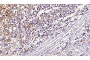 ABIN6272656 at 1/100 staining Human liver cancer tissue by IHC-P. (DNER Antikörper  (Internal Region))