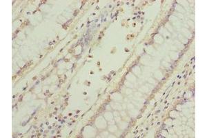 Immunohistochemistry of paraffin-embedded human colon cancer using ABIN7165317 at dilution of 1:100 (EFR3B Antikörper  (AA 1-298))
