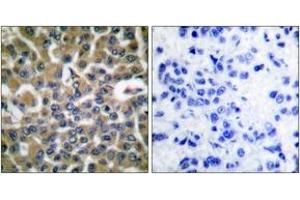 Immunohistochemistry analysis of paraffin-embedded human breast carcinoma tissue, using eEF2 (Ab-56) Antibody. (EEF2 Antikörper  (AA 31-80))