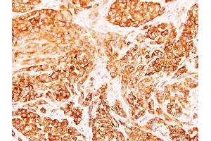 IHC-P Image Immunohistochemical analysis of paraffin-embedded A549 xenograft, using Diablo, antibody at 1:500 dilution. (DIABLO Antikörper)