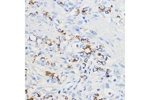 Immunohistochemistry of paraffin-embedded Human oophoroma using BOL Rabbit pAb (ABIN7265891) at dilution of 1:50 (40x lens). (BOLA3 Antikörper  (AA 1-68))