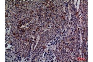 Immunohistochemistry (IHC) analysis of paraffin-embedded Human Lung Cancer, antibody was diluted at 1:100. (CDC34 Antikörper  (Internal Region))