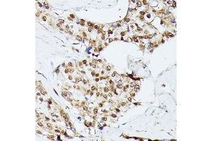 Immunohistochemistry of paraffin-embedded human breast cancer using KIF22 antibody  at dilution of 1:100 (40x lens). (KIF22 Antikörper  (AA 456-665))
