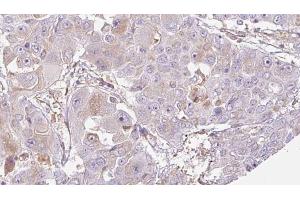 ABIN6272705 at 1/100 staining Human liver cancer tissue by IHC-P. (OR52J3 Antikörper  (N-Term))