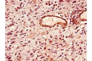Immunohistochemistry of paraffin-embedded human glioma using ABIN7155905 at dilution of 1:100 (LIPE Antikörper  (AA 1-251))