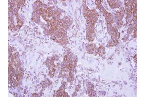 IHC-P Image Immunohistochemical analysis of paraffin-embedded human breast cancer, using CD79b, antibody at 1:250 dilution.