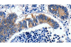 Immunohistochemistry of paraffin-embedded Human colon cancer tissue using GAD2 Polyclonal Antibody at dilution 1:30 (GAD65 Antikörper)